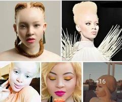Albinism Shines Bright in the Glare of Entertainment’s Spotlight